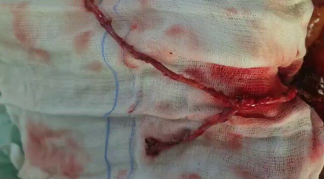 Traditional CABG - Dr. Kishor Deore